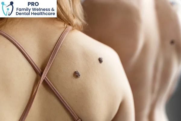 Mole and Warts Removal